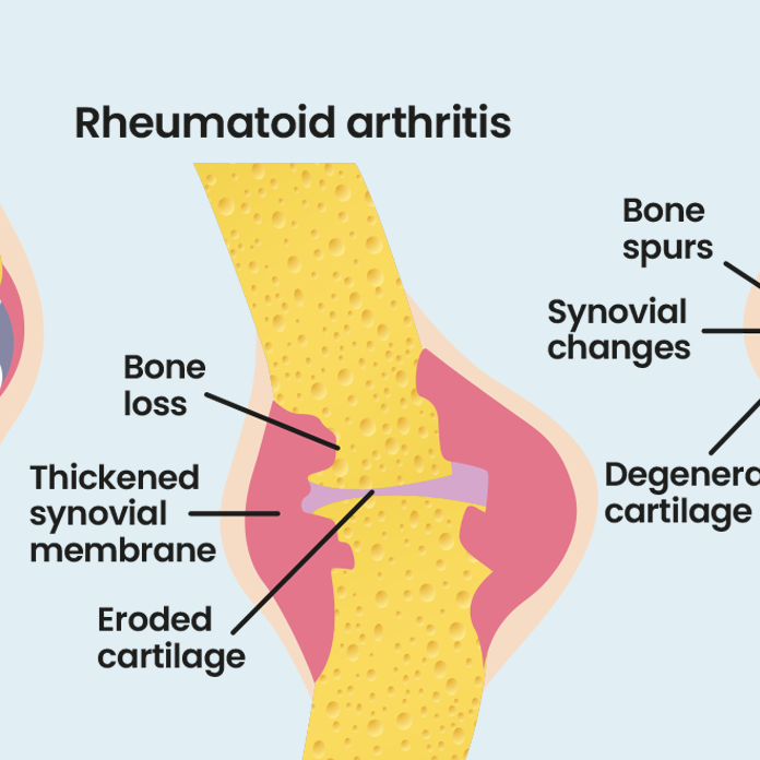 rheumatoid arthritis definition)