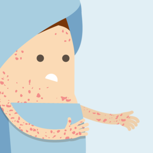 Illustration of a person with a rash on their skin.