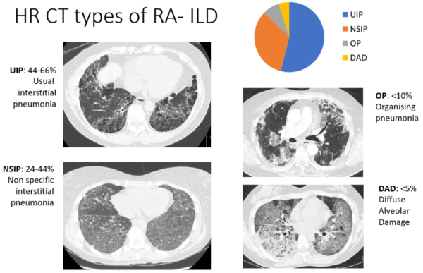 The Effects Of Ra On The Lungs Nras