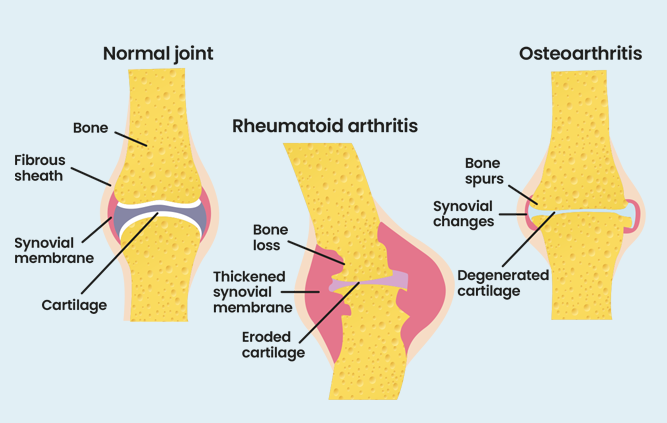 rheumatoid arthritis definition)