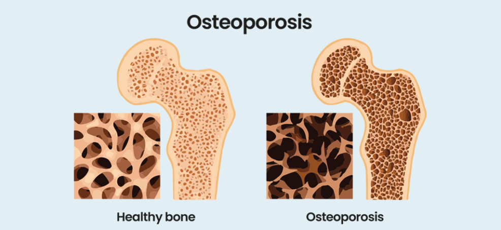 Osteoporosis in RA | NRAS