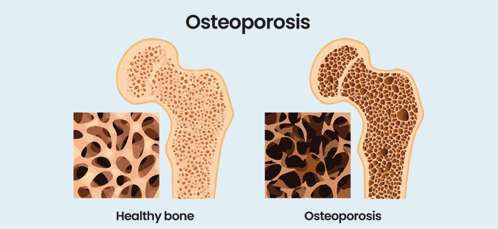 osteoporosis és arthrosis kezelése)