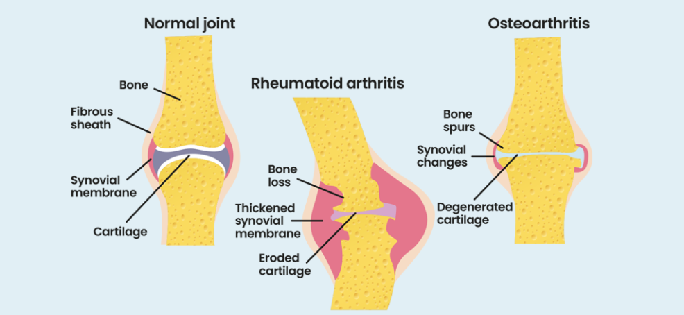 what-is-ra-rheumatoid-arthritis-explained-nras