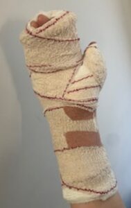Photograph of a bandaged hand after hand surgery