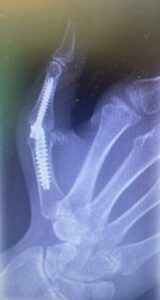 Photograph of a hand X-ray, focusing on the thumb, with surgical implants.