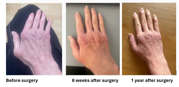 Photograph of a hand pre surgery, 6 weeks after surgery and 1 year after surgery. It shows straightened fingers post surgery and reduced swelling one year on.